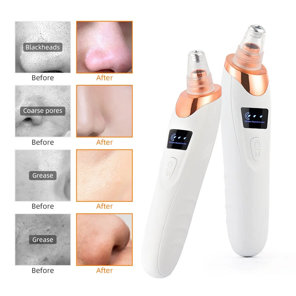 blackhead removal device before after videos - Beauty Devices - Blackhead Remover